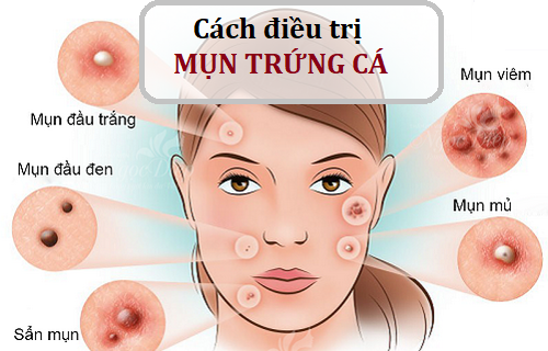 NHỮNG ĐIỀU CẦN BIẾT MỤN TRỨNG CÁ